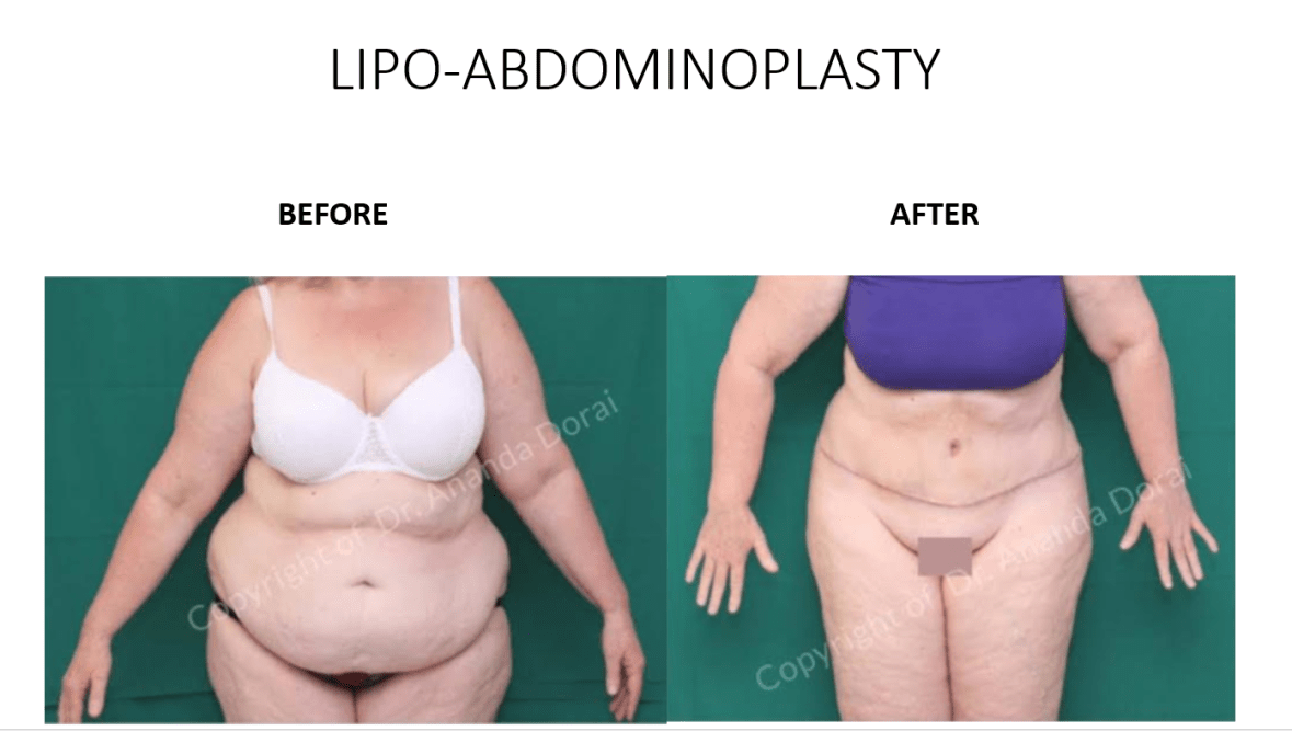 lipo abdominoplasty 1